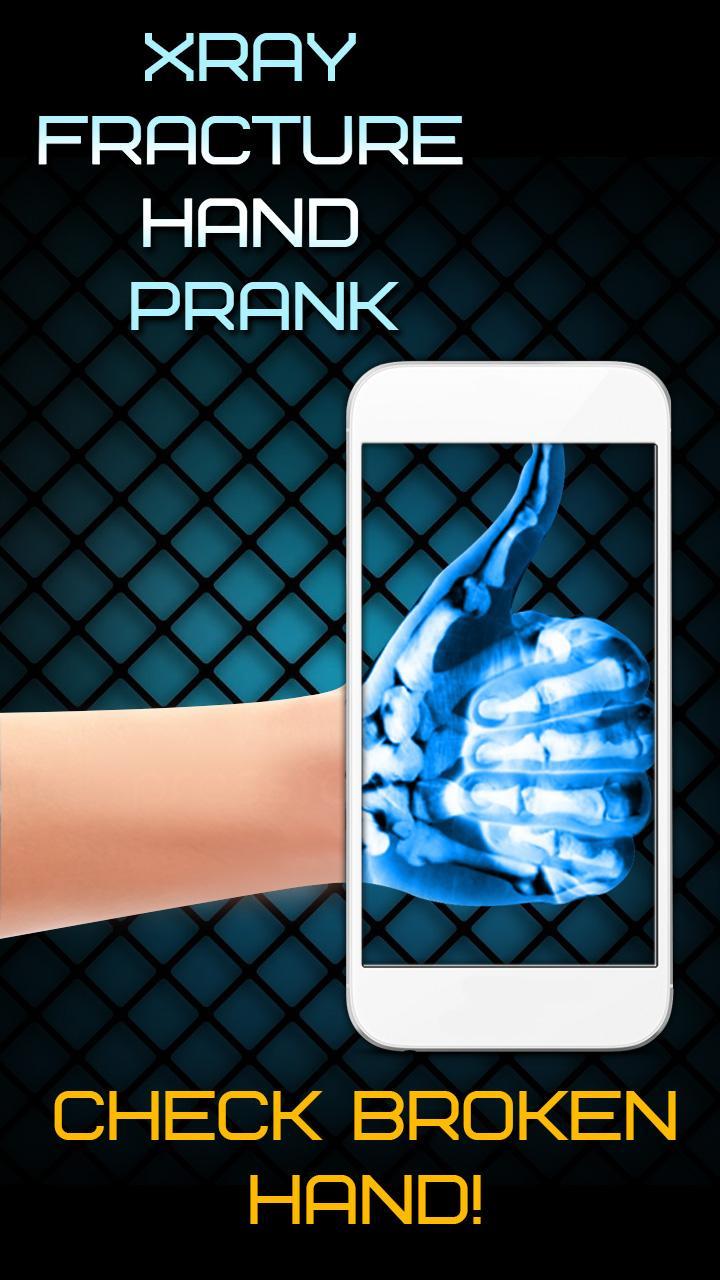 Xray Fracture Hand Prank