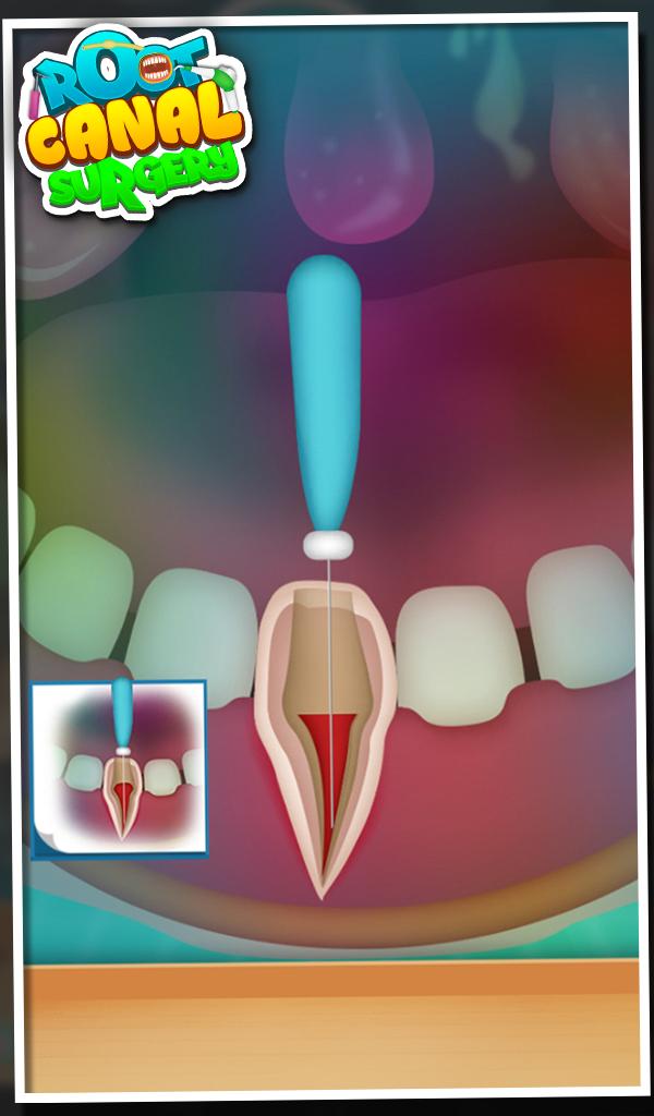 Root Canal Surgery